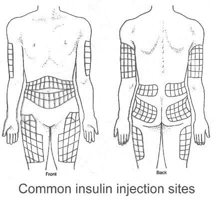 Lantus Injection Guide Lantus – Abu-Ali Sina Charity Hospital